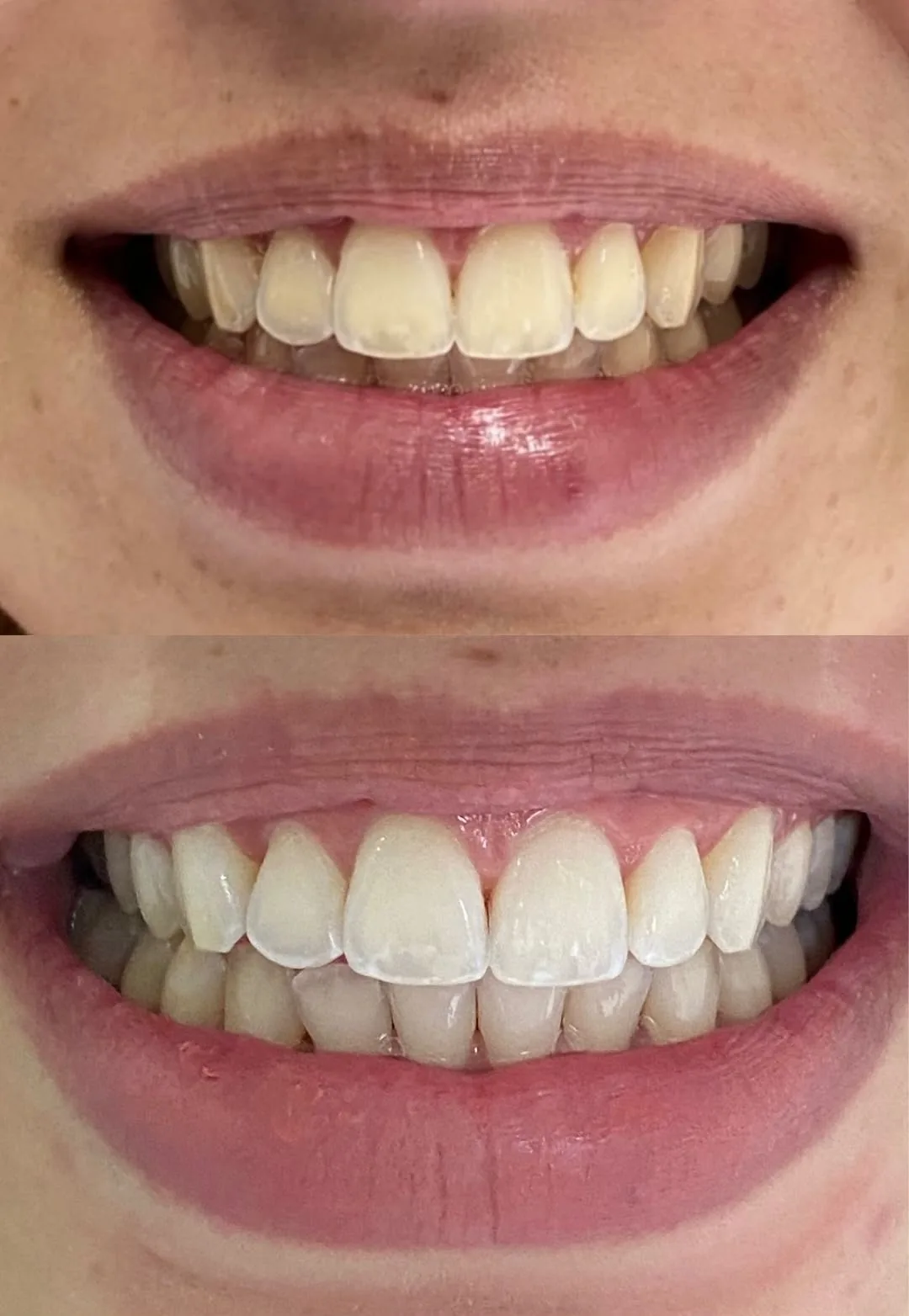 Clareamento dental
